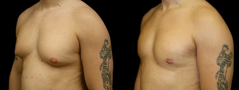 Gynecomastia Patient 15 Before & After Details