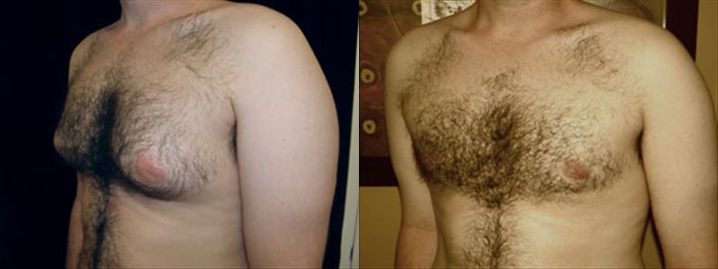 Gynecomastia Patient 3 Before & After Details