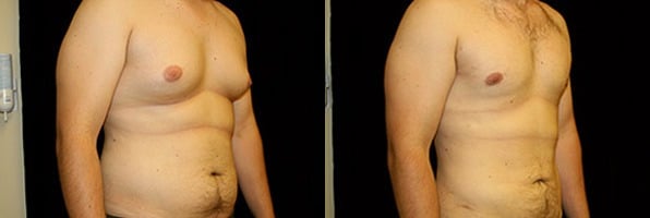 Gynecomastia Patient 17 Before & After Details