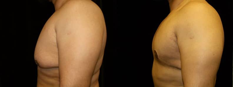 Gynecomastia Patient 3 Before & After Details