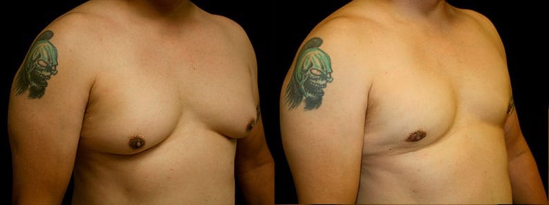 Gynecomastia Patient 16 Before & After Details