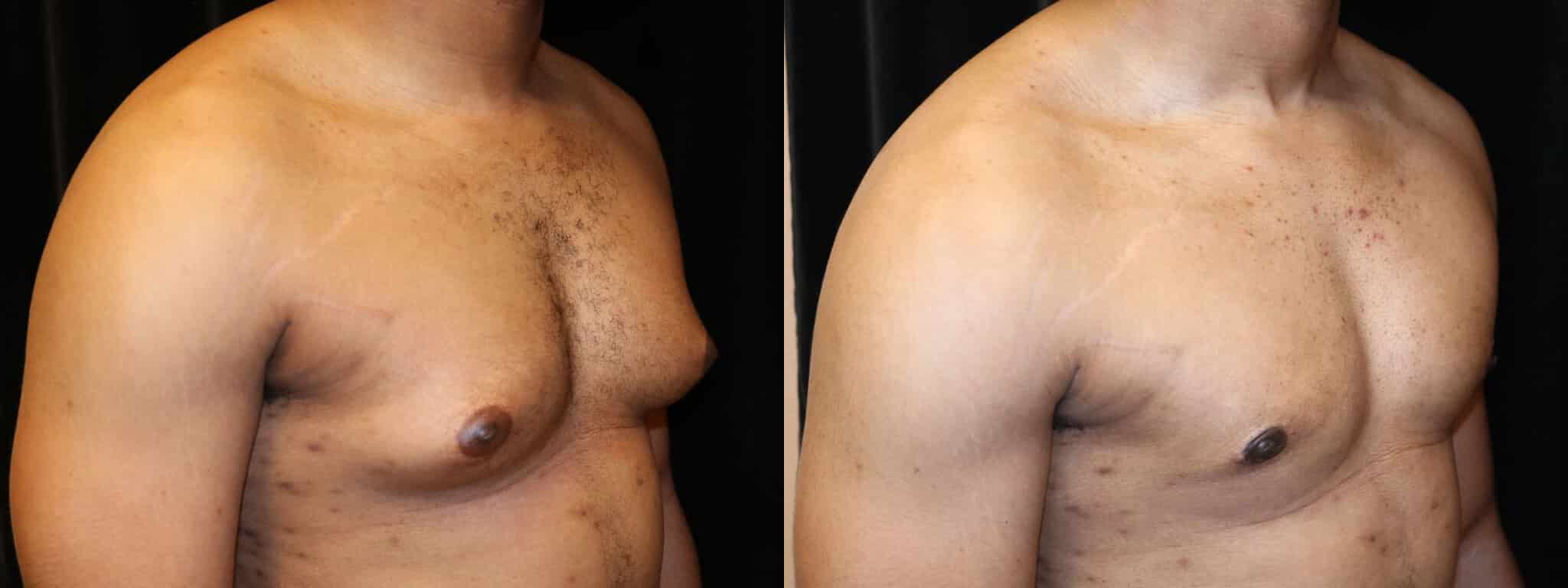 Gynecomastia Patient 13 Before & After Details