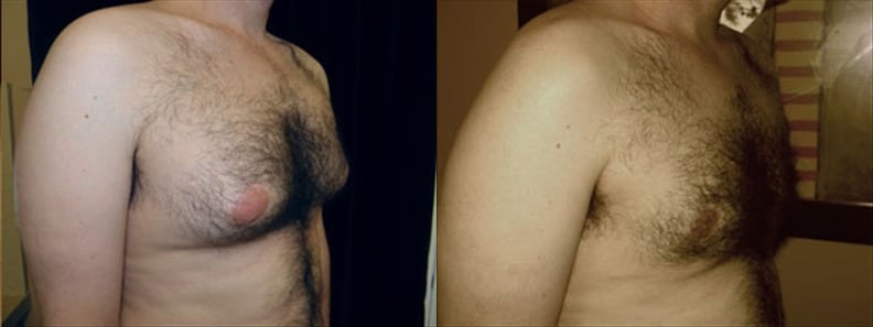 Gynecomastia Patient 3 Before & After Details