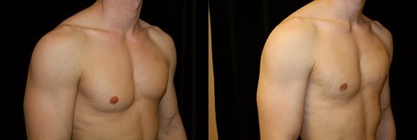 Gynecomastia Patient 9 Before & After Details