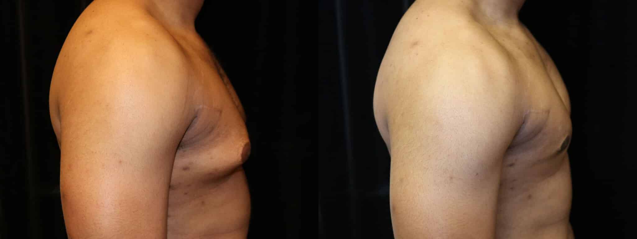 Gynecomastia Patient 13 Before & After Details