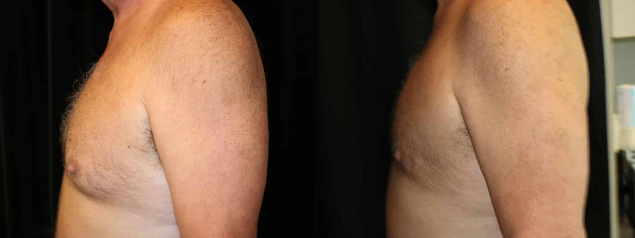 Gynecomastia Patient 9 Before & After Details