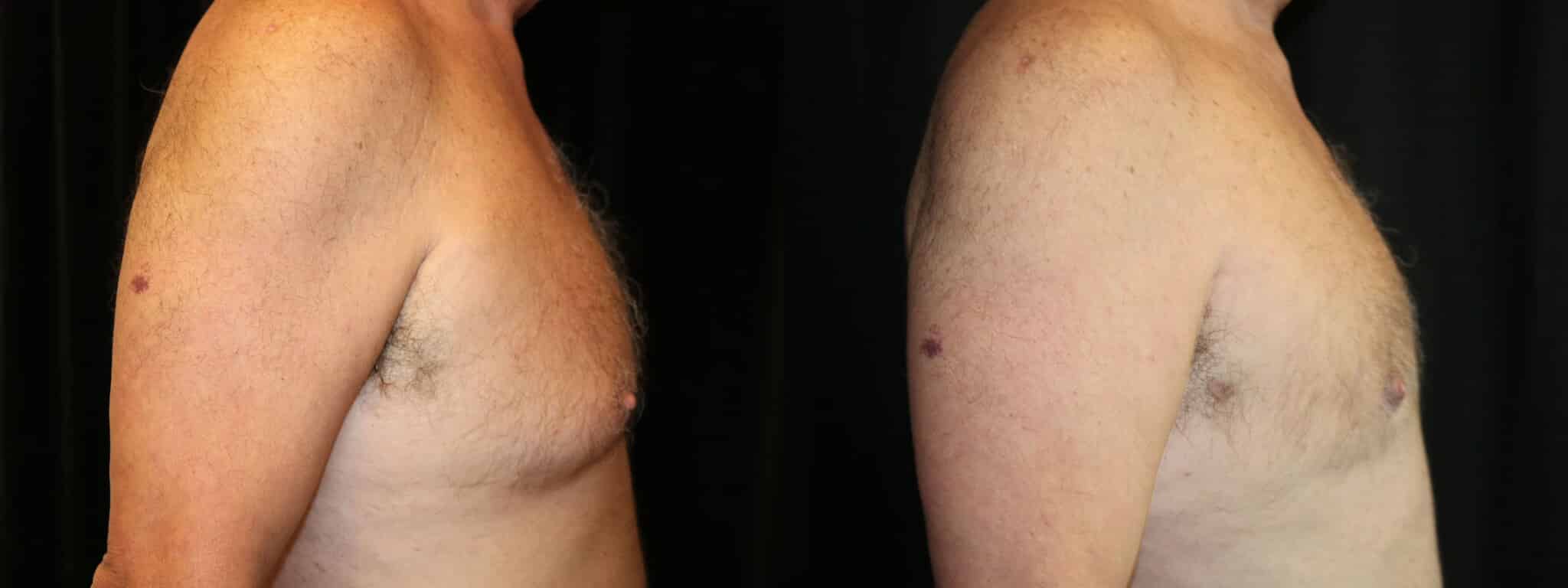 Gynecomastia Patient 9 Before & After Details