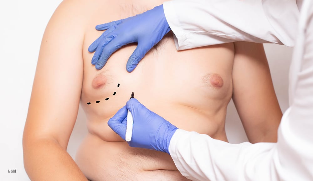 Plastic surgeon marks gynecomastia area