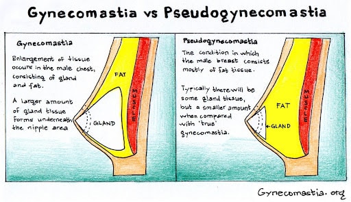 Understanding Gynecomastia infographic