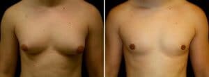 Before and after Gynecomastia treatment. Steroid induced gynecomastia treated with glandular breast tissue removal - Male breast reduction.