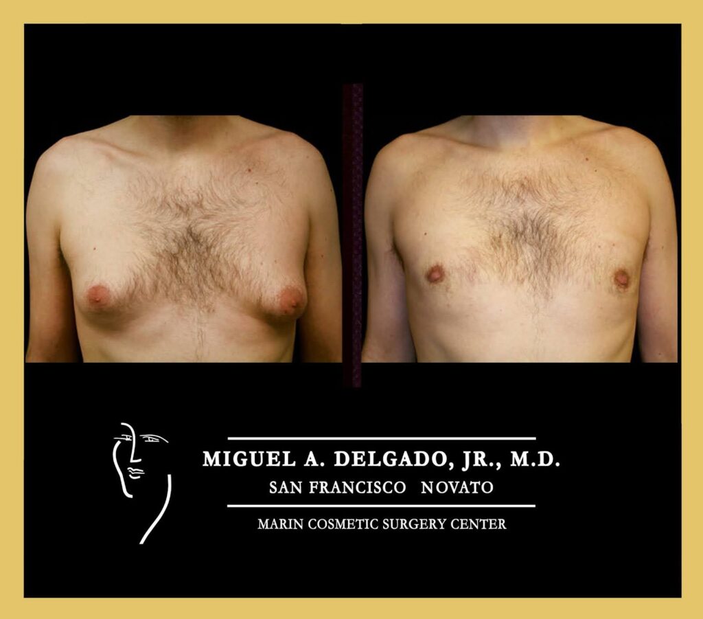 Before and after photo of a patient after gynecomastia surgery.