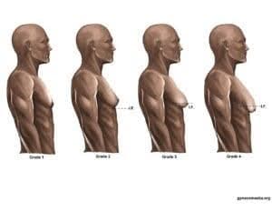 Images depicting the stages of gynecomastia, from Grade 1 with puffy nipples to Grade 4 with excess skin.