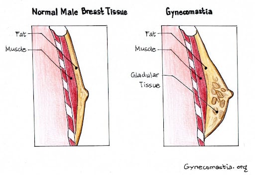 Gynecomastia in Adolescent Males